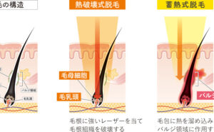 脱毛の料金・回数